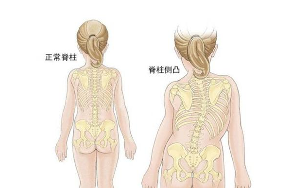 [国康资讯]儿童综合素质测试仪早发性脊柱侧凸-儿童显著的成长和发育障碍
